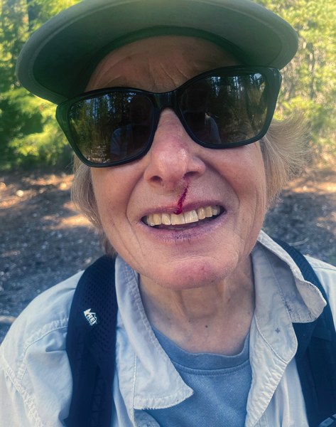 Oregon's blowdown on a Bend area trail left their mark. Grandson Cayesh patched up Nancy and dark glasses concealed further July 2023 damage.jpg